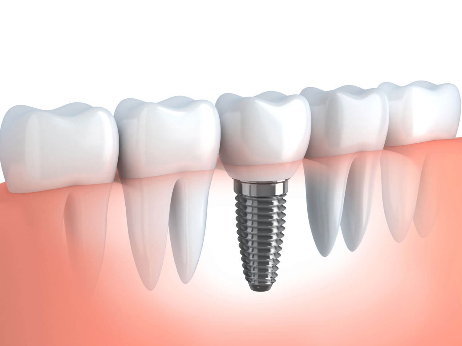 dental-implant-types